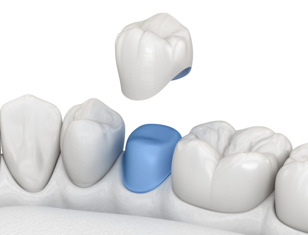 CEREC Crown vs Traditional Crown: Choose the Right Fit
