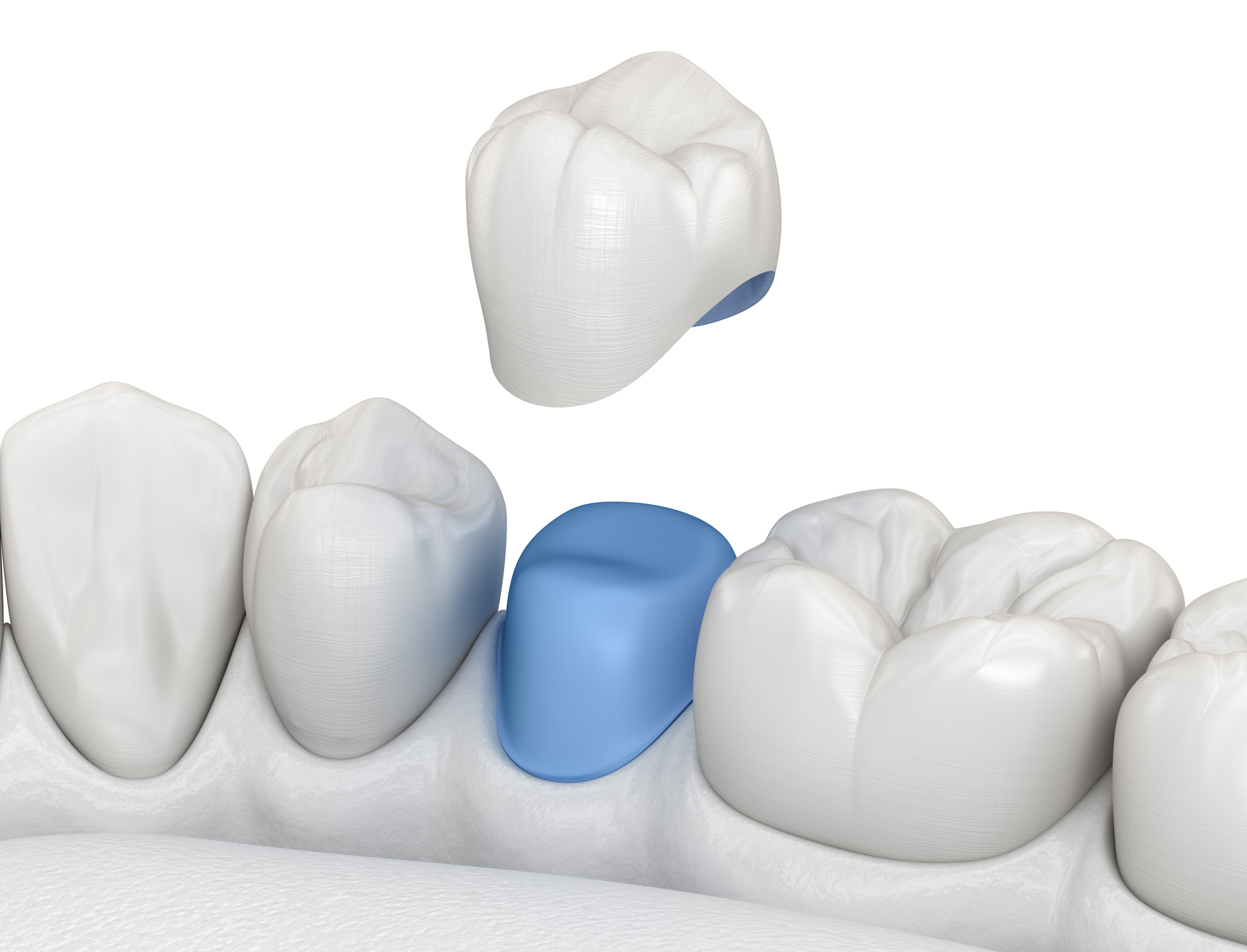CEREC Crown vs Traditional Crown: Choose the Right Fit