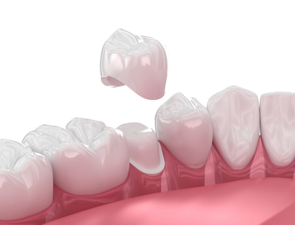 CEREC Crown vs Traditional Crown